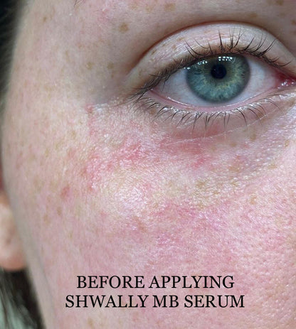 NEW Shwally Methylene Blue Repair Serums by Shwally